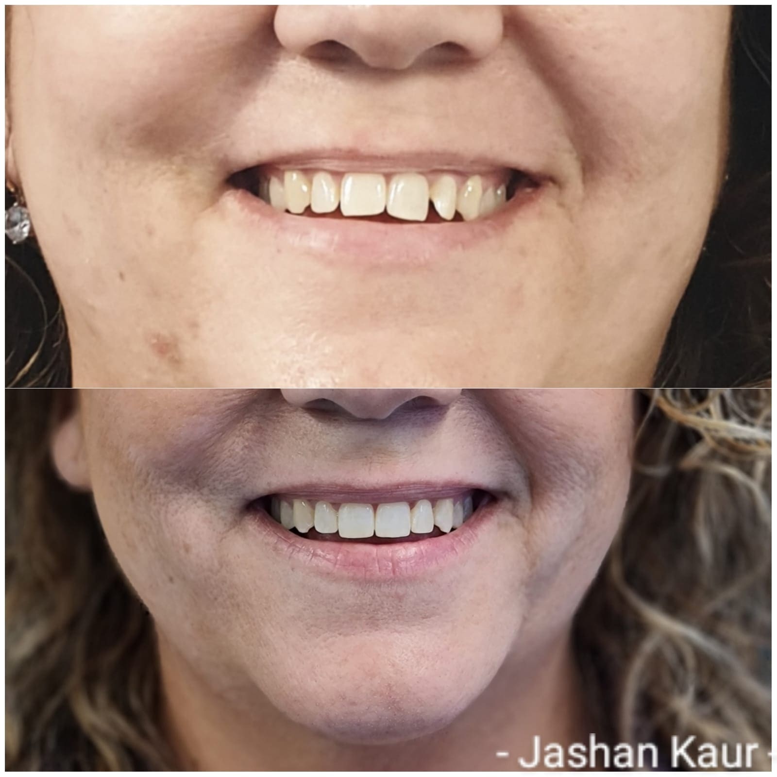 Campbelltown Family Dental Care Zoom bleaching november 2020