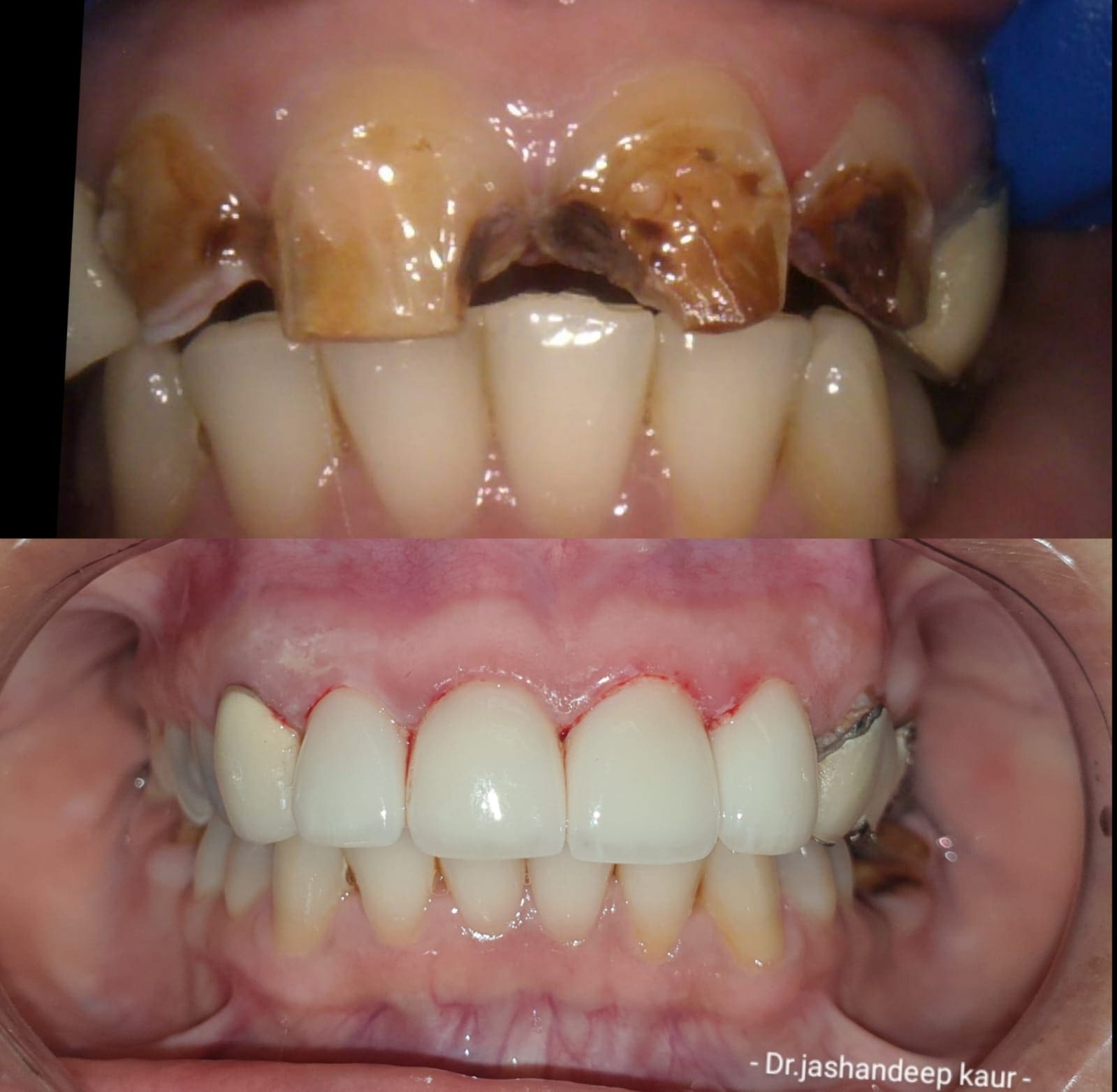 Campbelltown Family Dental Care Composite veneer 19-11-20