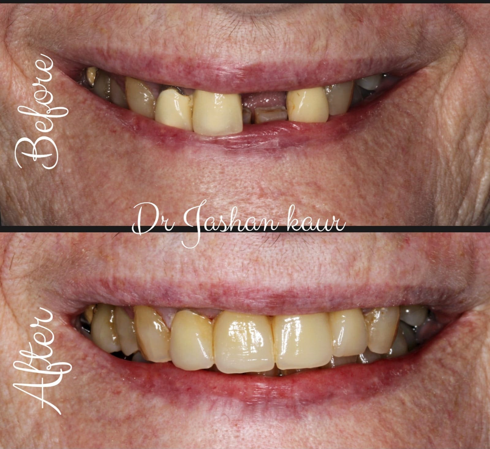 Campbelltown Family Dental Care Composite veneer 19-11-20