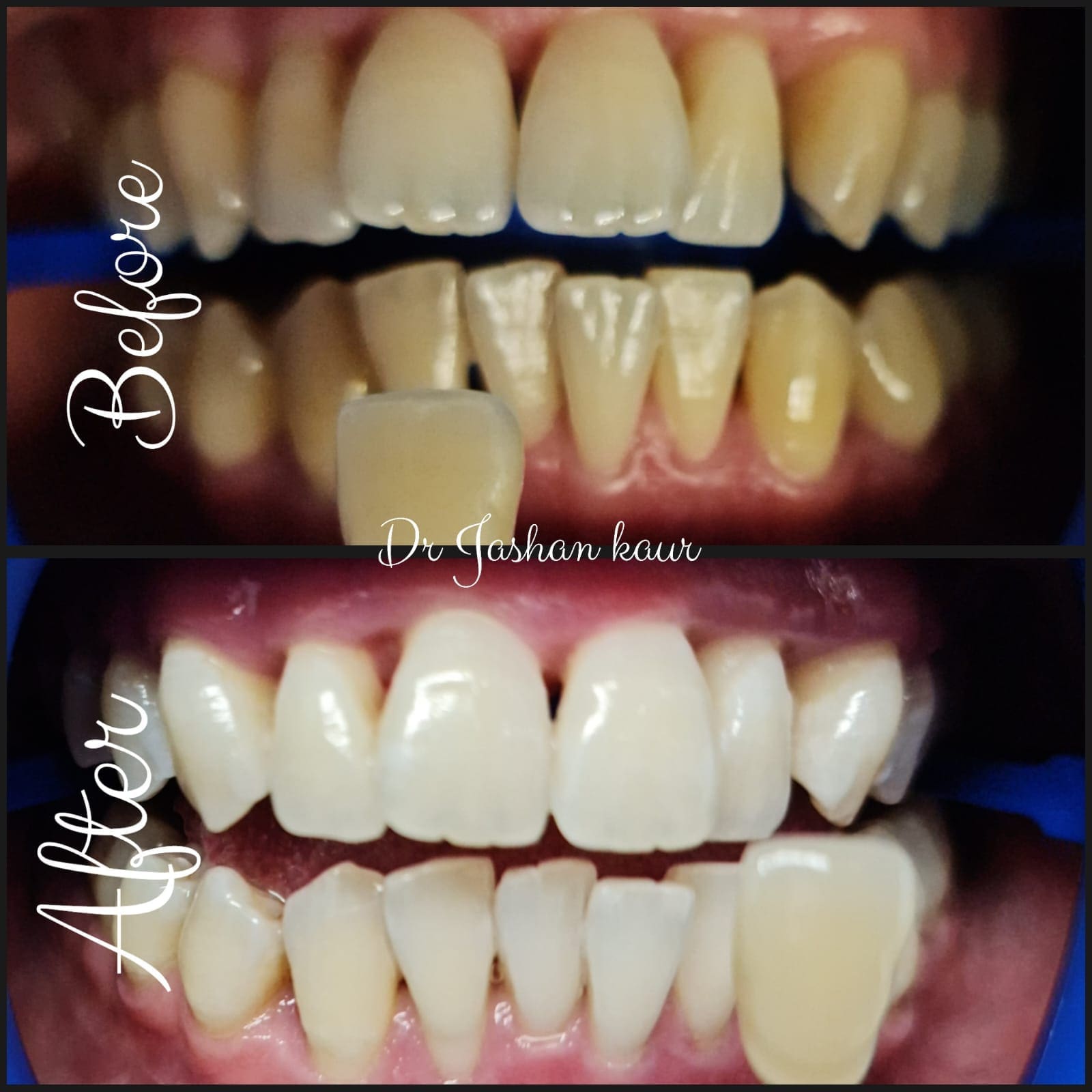 Campbelltown Family Dental Care Composite veneer 19-11-20