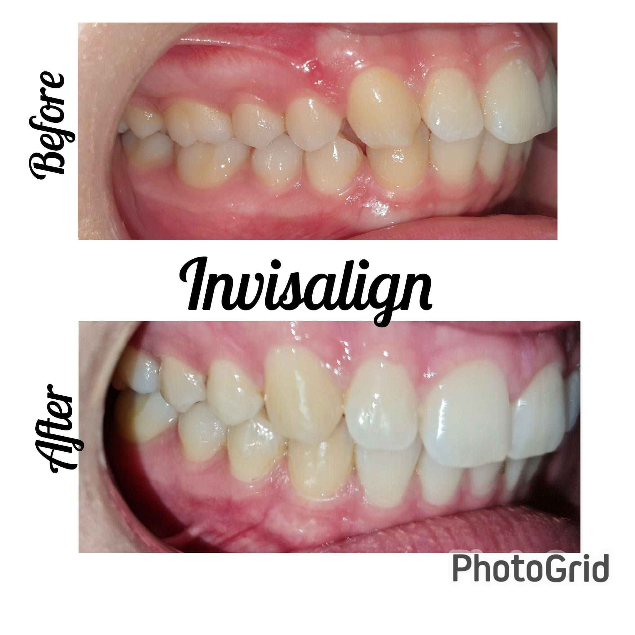 Campbelltown Family Dental Care Composite veneer 19-11-20