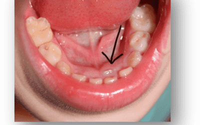 Lower Incisor Crowding