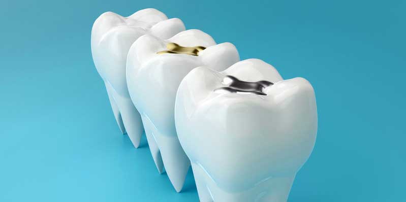 How Long Do Dental Fillings Last? Will They Fall Out?