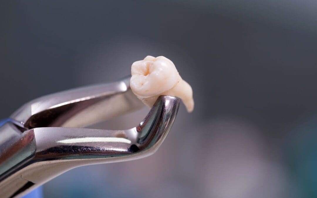 Things To Remember To Prepare For Your Next Scheduled Tooth Extraction