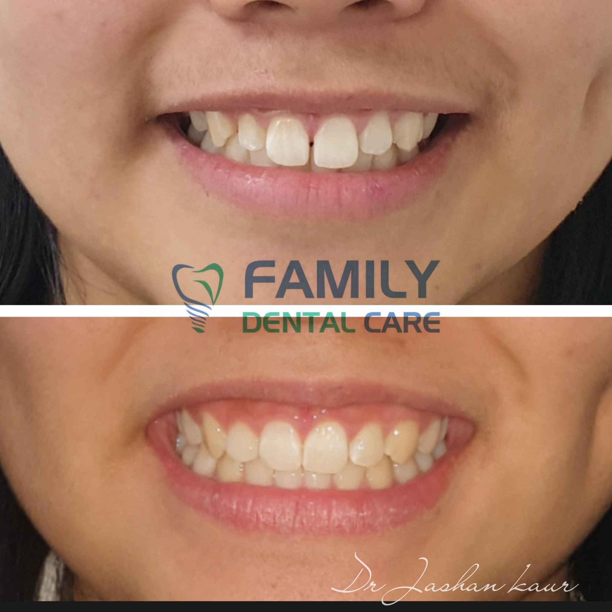 Campbelltown Family Dental Care Composite veneer 19-11-20