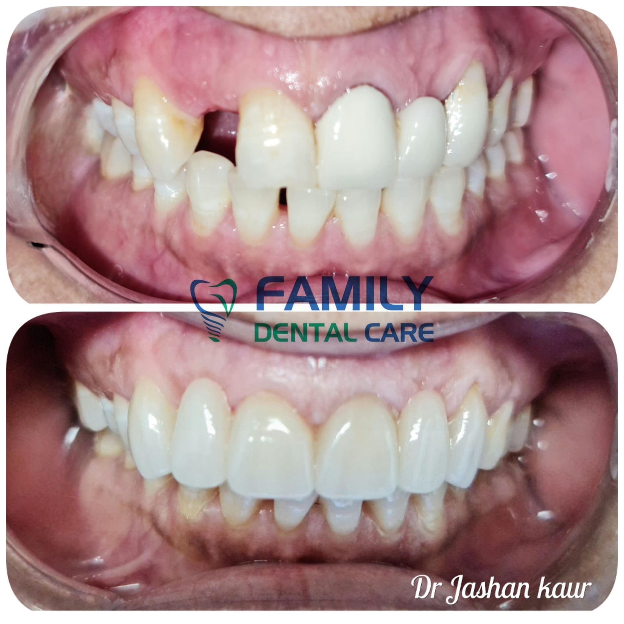 Campbelltown Family Dental Care Composite veneer 19-11-20